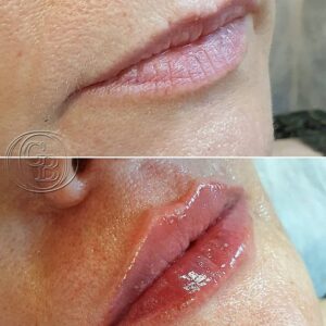 Tratamiento de labios