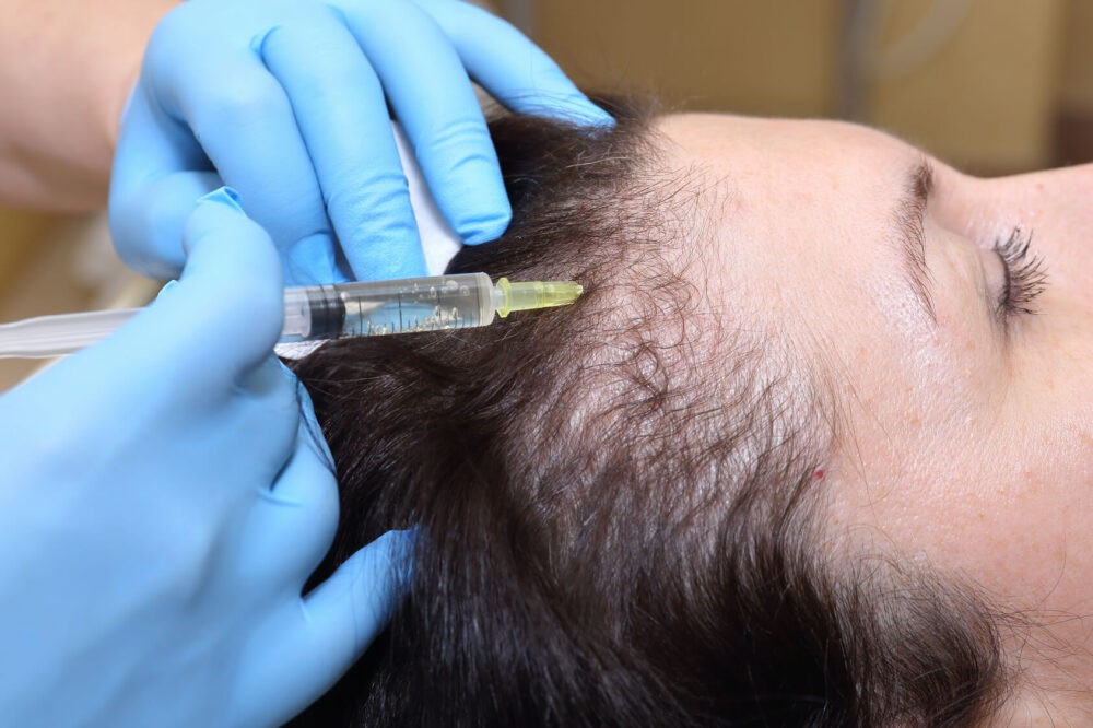 Tratamiento alopecia y caída del pelo