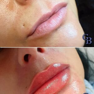 acido hialuronico aumento de labios
