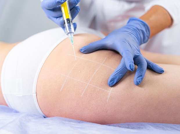 Cuánto duran los resultados de la mesoterapia